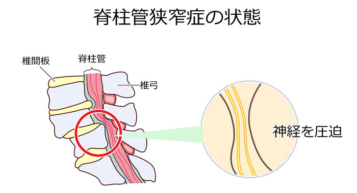 脊柱管狭窄症の状態